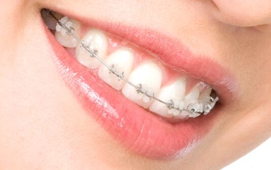 Як вибрати ортодонтичну конструкцію: поради експертів