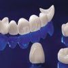 Восстановление зуба: какие способы существуют и какой наилучший